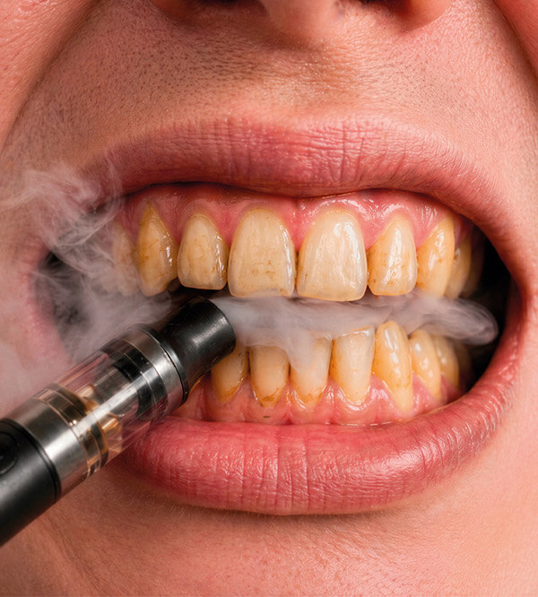 Primer plano de una boca con dientes manchados sosteniendo un vape